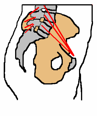 The Ballance between the Psoas and Multifidis 
muscles