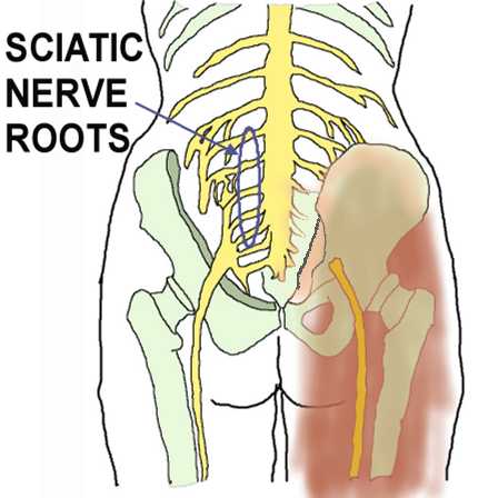 Nerve Root L5 can be squeezed