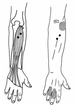 Extensor Digitorum muscle with
trigger points and pain referral pattern