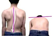 scoliosis adams test boy