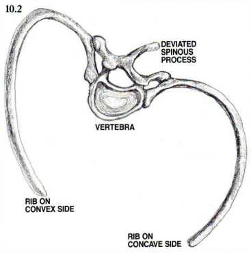 Scoliotic Ribs