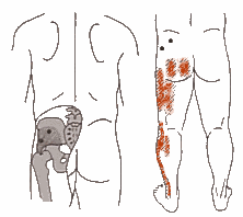 Diagram, Gluteus minimus trigger points and referred pain zone
