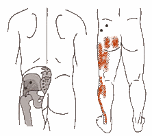 Diagram, Gluteus minimus trigger points and combined trigger point patterns