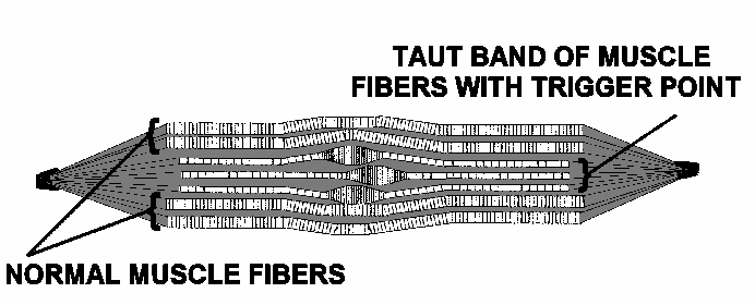 Trigger Point Diagram