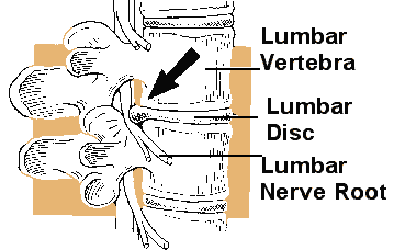 Lumbar Spine, Siatic Nerve Injury - Lateral View