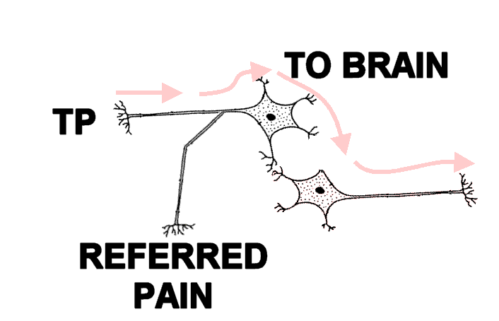 Trigger Point Pain Referral - Diagram of Axon Branching