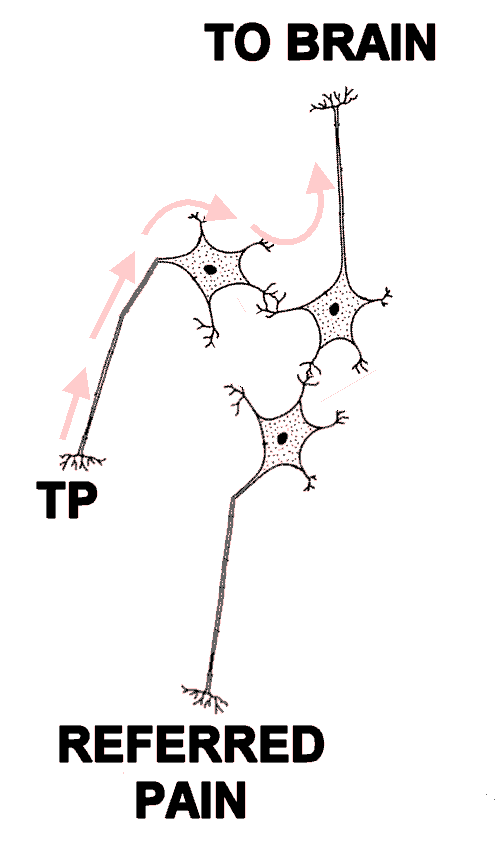 Trigger Point Pain Referral - Diagram of Convergence Projection