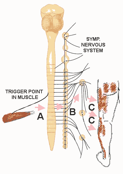 Trigger Point Pain Referral - Diagram of Convergence Facilitation